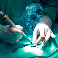 Рис. 4. Лазерное лечение анальной трещины избавляет от проблемы.