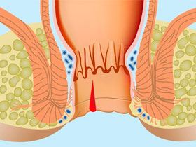 Рис. 1 Трещина заднего прохода внутри ануса