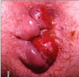 Рис. 2 Микротрещины вокруг ануса, возникающие при геморрое вызывают сильный зуд и кровотечение из заднего прохода
