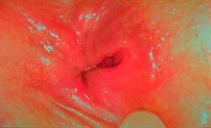 Рис. 3 Своевременная диагностика и лечение трещины заднего прохода - это профилактика рака ануса