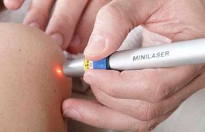 Рис. 3 Лазерное иссечение кисты копчика на фоне лечения антибиотиками дает превосходные результаты