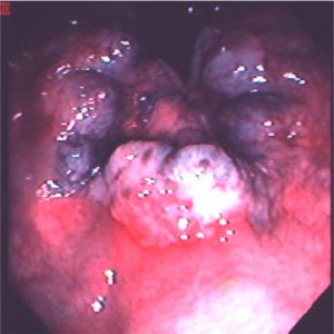 Рис.1 Геморроидальные узлы - это увеличение венозных сосудов анальной области кишечника. Внутренние геморроидальные узлы