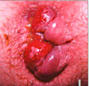 Рис.2 Геморроидальные узлы, особенно внутренние, часто проявляются кровотечением из ануса