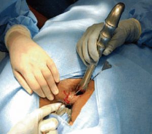 Рис. 3. Фистулотомия - операция рассечения свища прямой кишки.